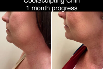 coolsculpting washington dc