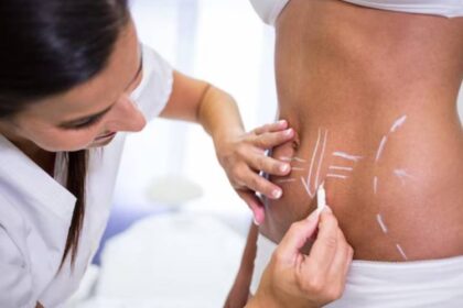 liposuction Washington DC
