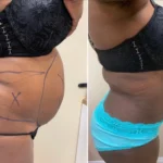 coolsculpting washington dc