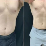 coolsculpting dc