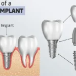 all-on-x dental implants