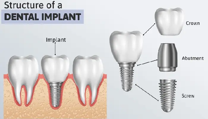 all-on-x dental implants