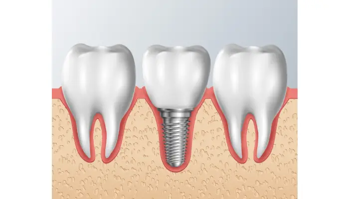 all-on-x dental implants