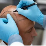 Hair Transplant in Istanbul