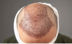 Hair Transplant in Istanbul
