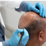 Hair Transplant in Istanbul