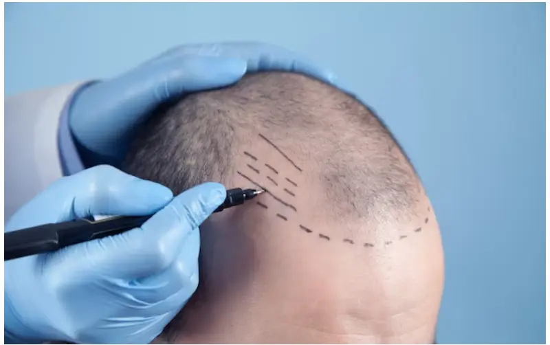 Hair Transplant in Istanbul